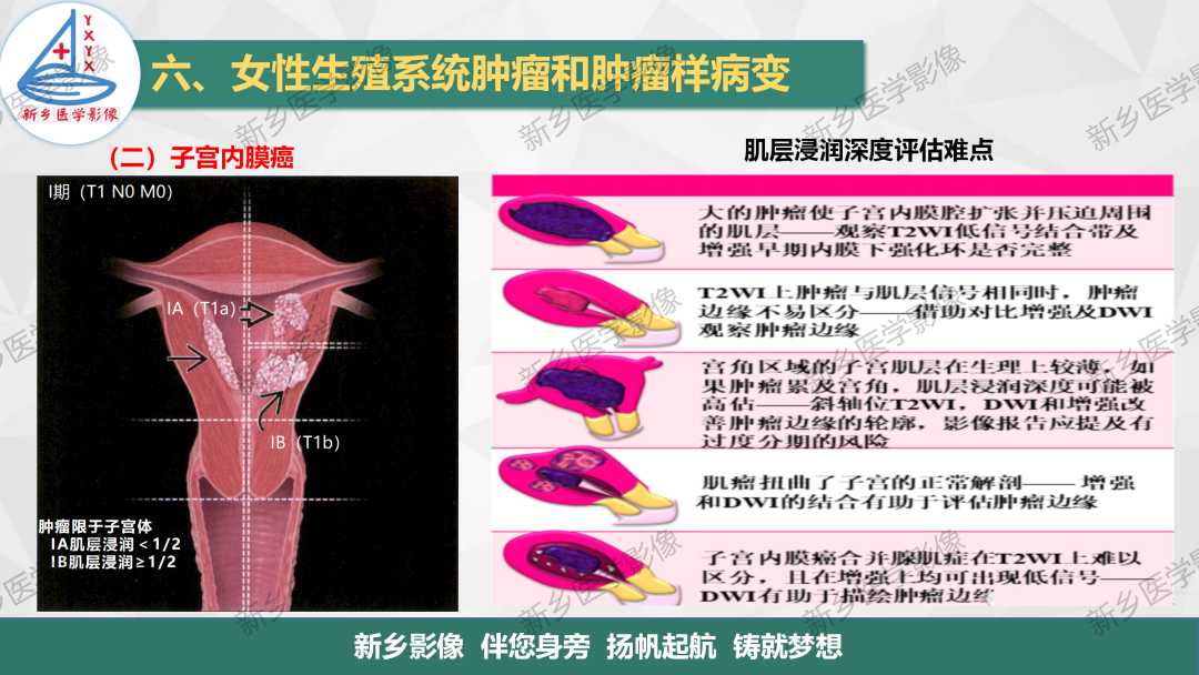 影像PPT - 【PPT】子宫内膜癌分期的影像表现-7