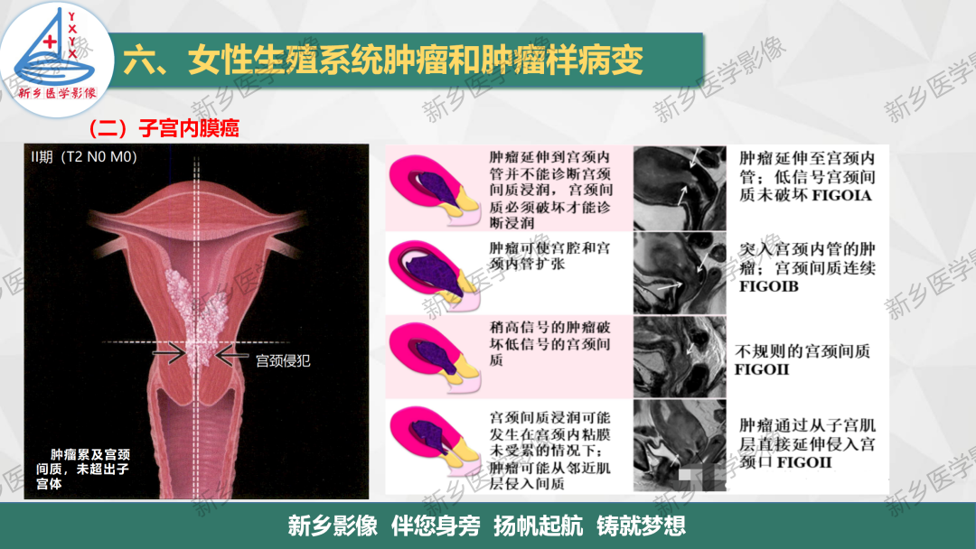 影像PPT - 【PPT】子宫内膜癌分期的影像表现-9