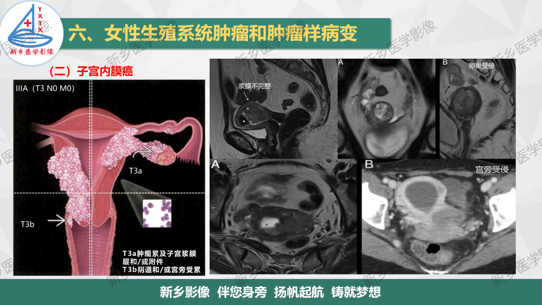 影像PPT - 【PPT】子宫内膜癌分期的影像表现-10