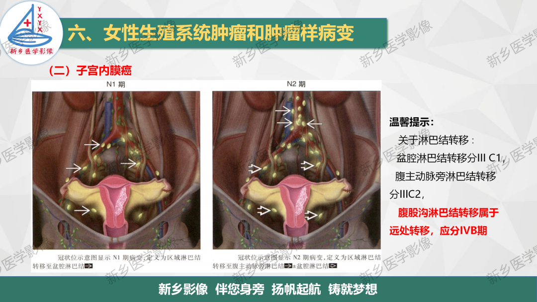 影像PPT - 【PPT】子宫内膜癌分期的影像表现-12