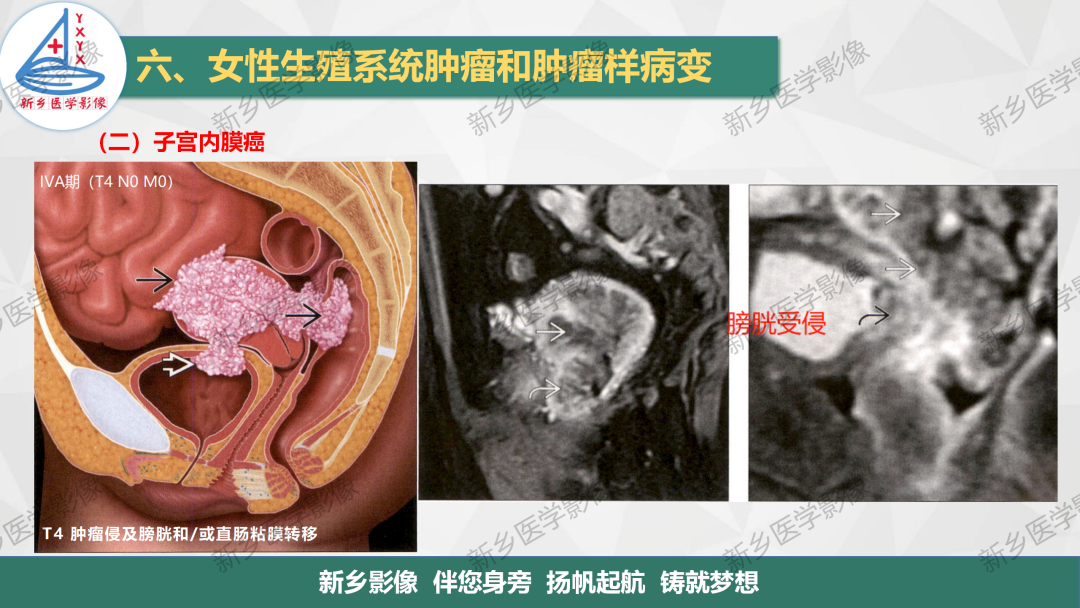 影像PPT - 【PPT】子宫内膜癌分期的影像表现-11
