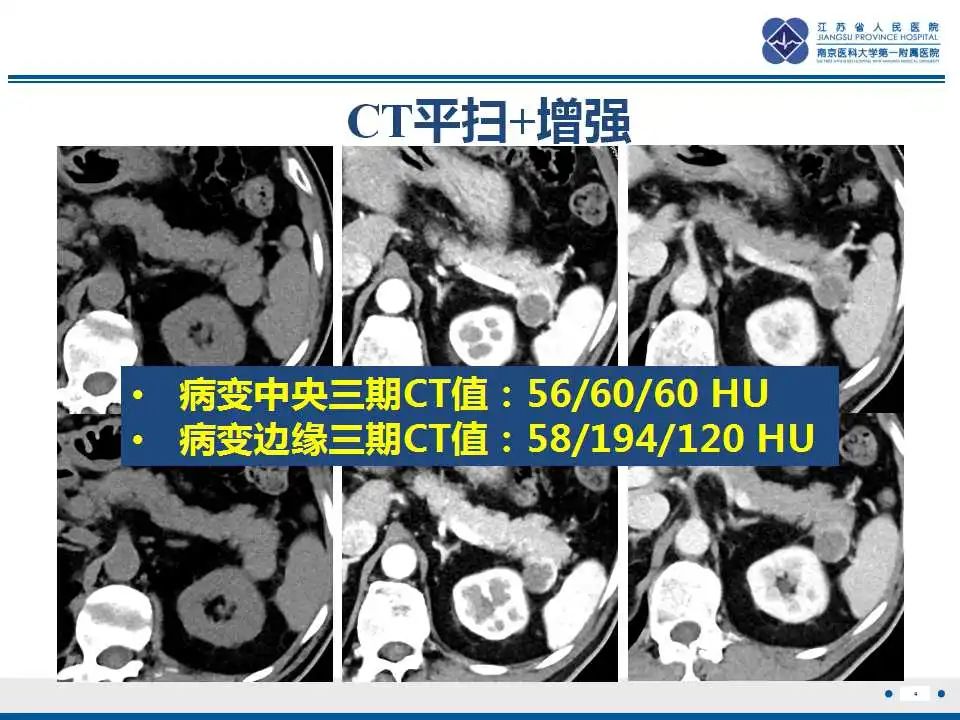 影像PPT - 【PPT】胰腺内异位副脾-4