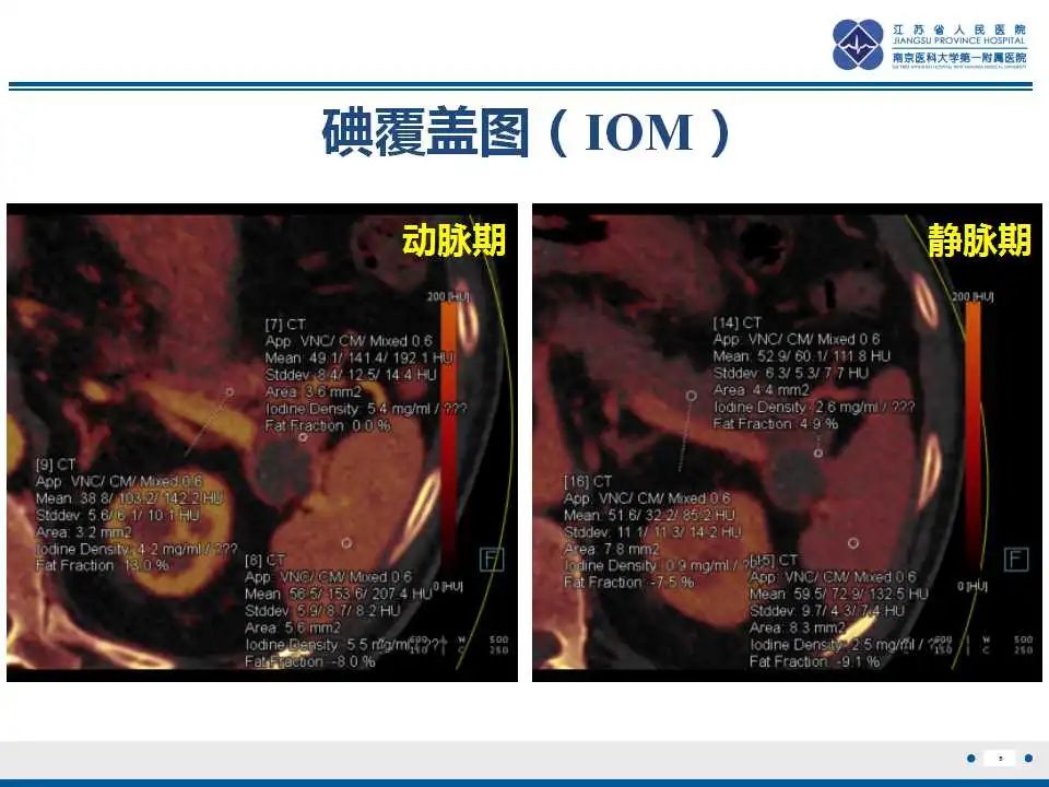 影像PPT - 【PPT】胰腺内异位副脾-5