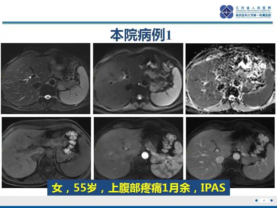 影像PPT - 【PPT】胰腺内异位副脾-27