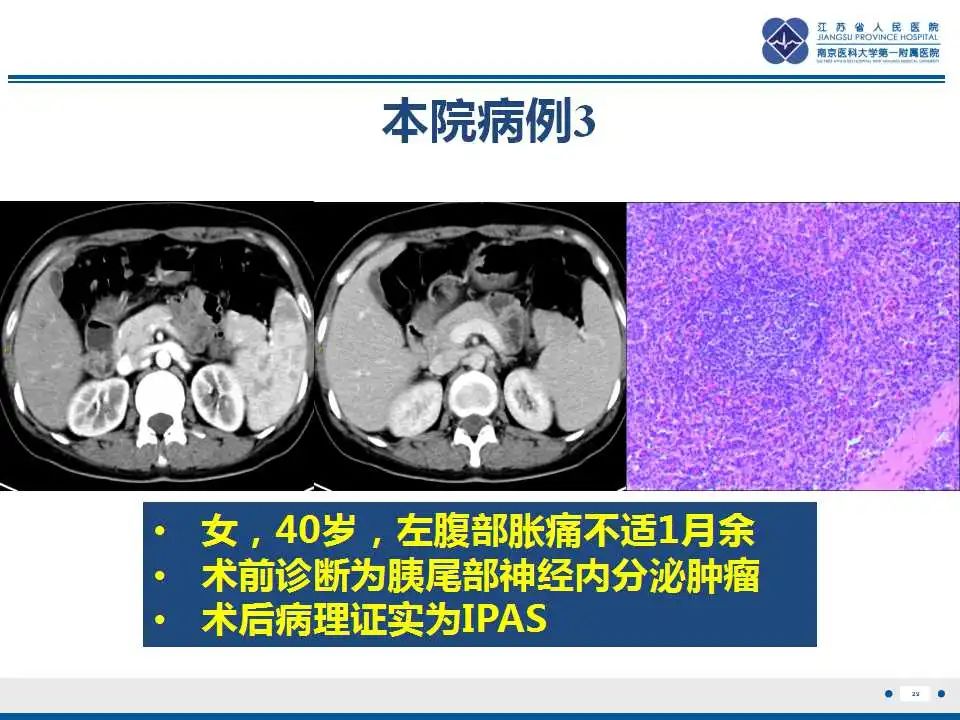 影像PPT - 【PPT】胰腺内异位副脾-29
