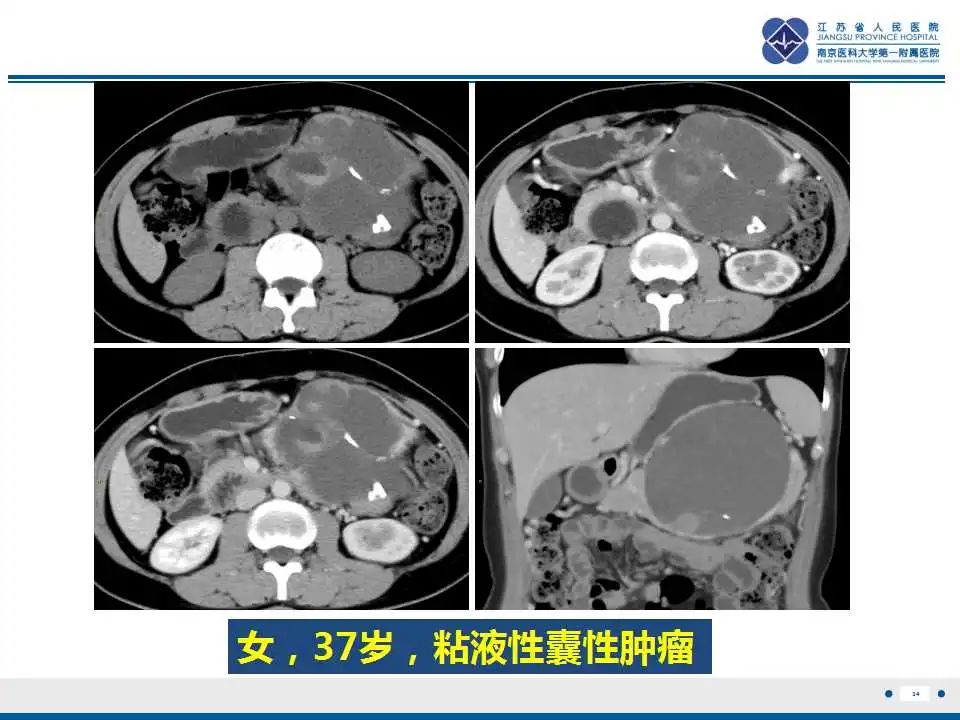 影像PPT - 【PPT】胰腺内异位副脾-34