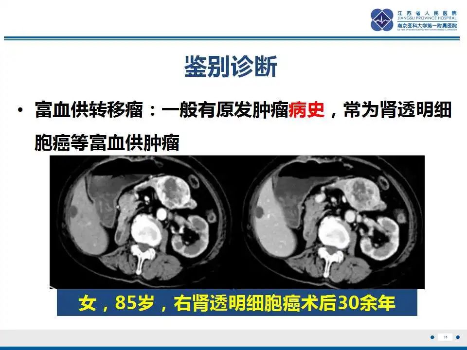 影像PPT - 【PPT】胰腺内异位副脾-35