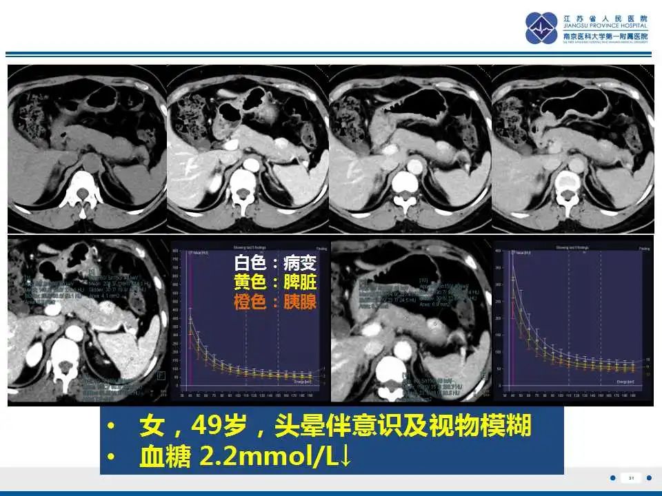 影像PPT - 【PPT】胰腺内异位副脾-31