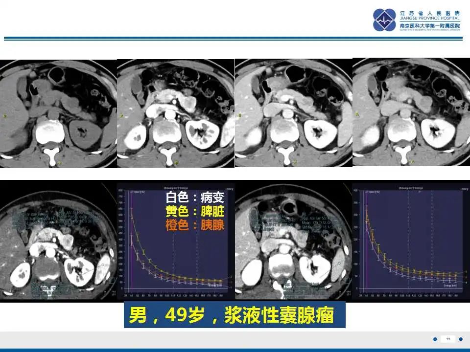 影像PPT - 【PPT】胰腺内异位副脾-33