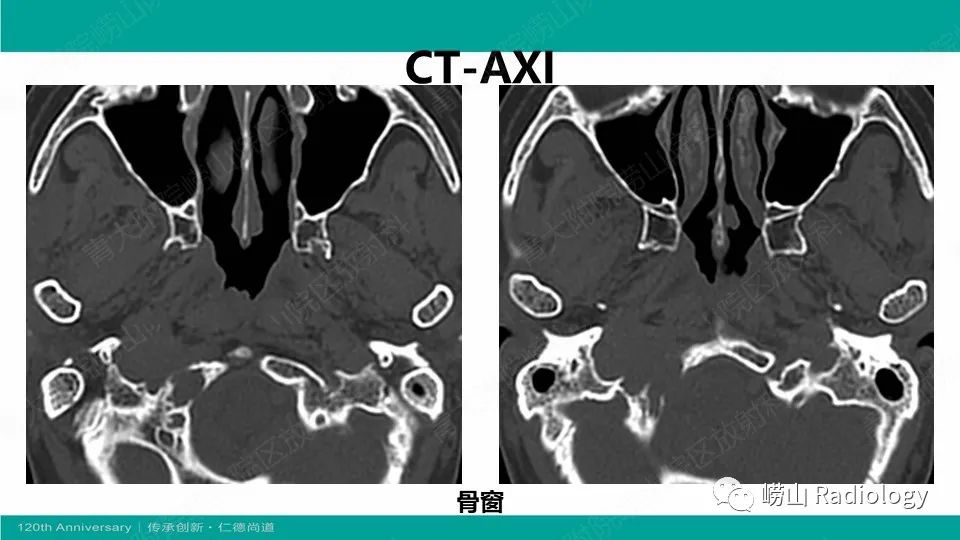 影像PPT - 【病例】颈静脉孔区副神经节瘤(颈静脉球瘤)1例CT及MR-5