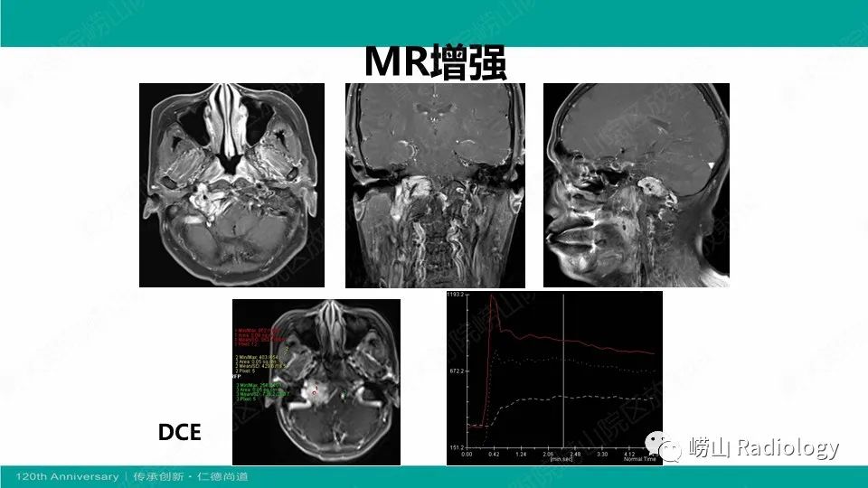 影像PPT - 【病例】颈静脉孔区副神经节瘤(颈静脉球瘤)1例CT及MR-9