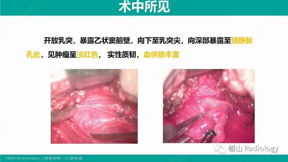 影像PPT - 【病例】颈静脉孔区副神经节瘤(颈静脉球瘤)1例CT及MR-11