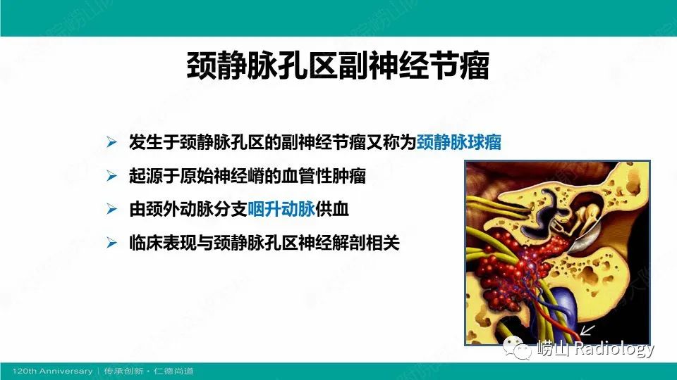 影像PPT - 【病例】颈静脉孔区副神经节瘤(颈静脉球瘤)1例CT及MR-13