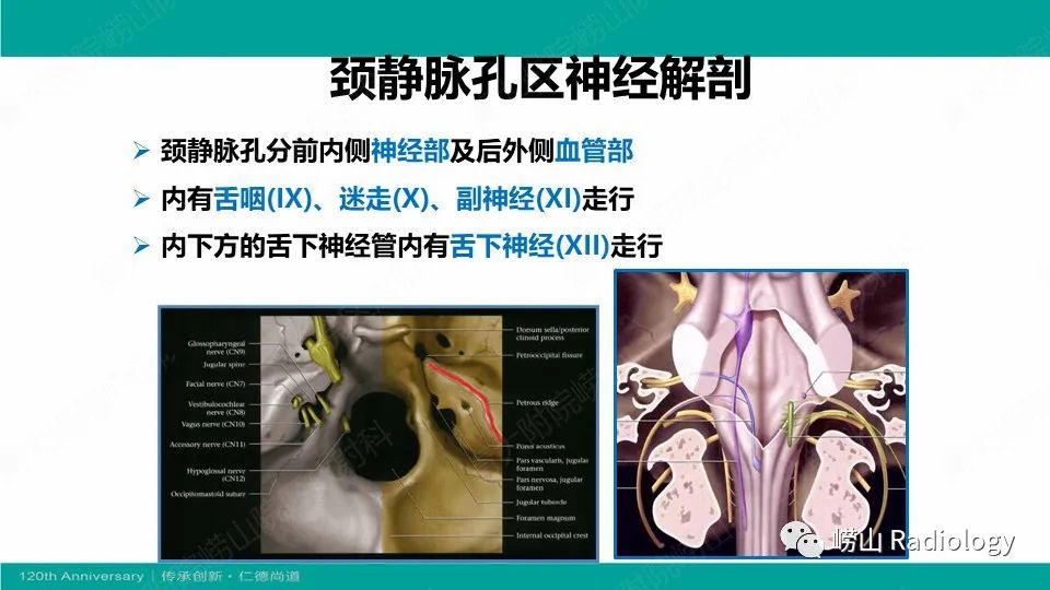 影像PPT - 【病例】颈静脉孔区副神经节瘤(颈静脉球瘤)1例CT及MR-14