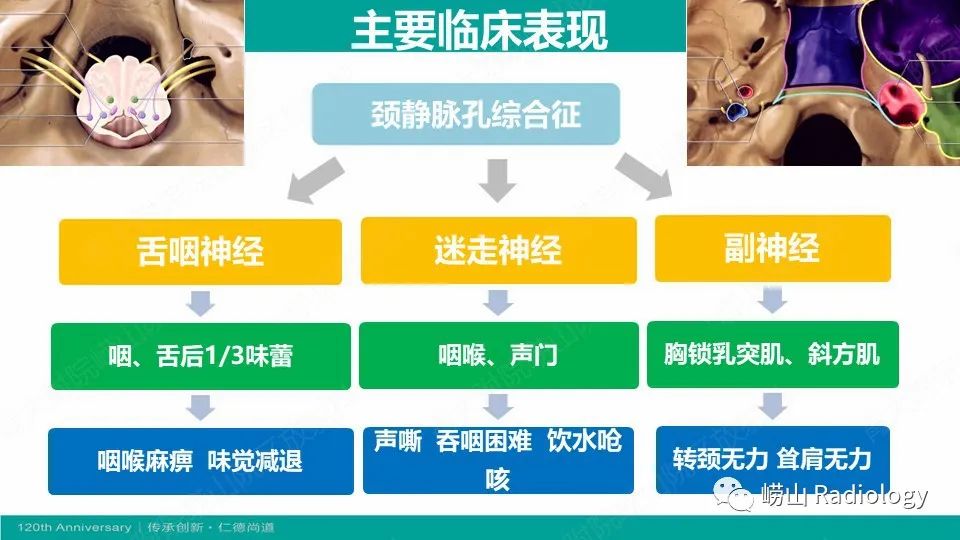 影像PPT - 【病例】颈静脉孔区副神经节瘤(颈静脉球瘤)1例CT及MR-15