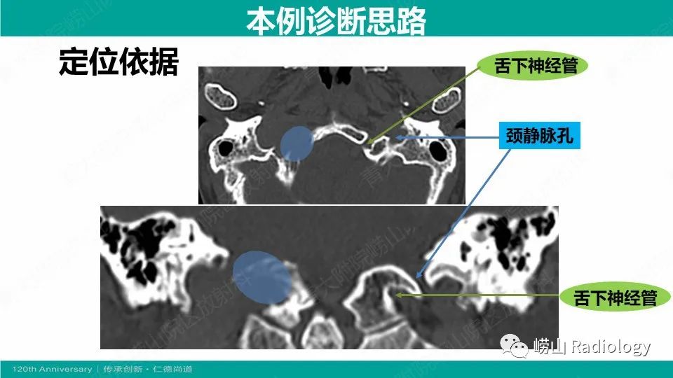 影像PPT - 【病例】颈静脉孔区副神经节瘤(颈静脉球瘤)1例CT及MR-18