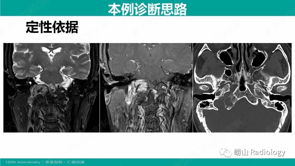 影像PPT - 【病例】颈静脉孔区副神经节瘤(颈静脉球瘤)1例CT及MR-19