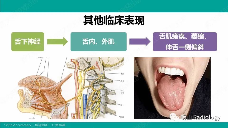 影像PPT - 【病例】颈静脉孔区副神经节瘤(颈静脉球瘤)1例CT及MR-16