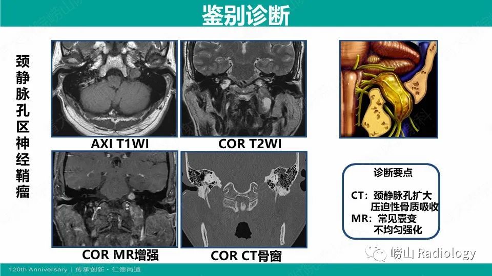 影像PPT - 【病例】颈静脉孔区副神经节瘤(颈静脉球瘤)1例CT及MR-22