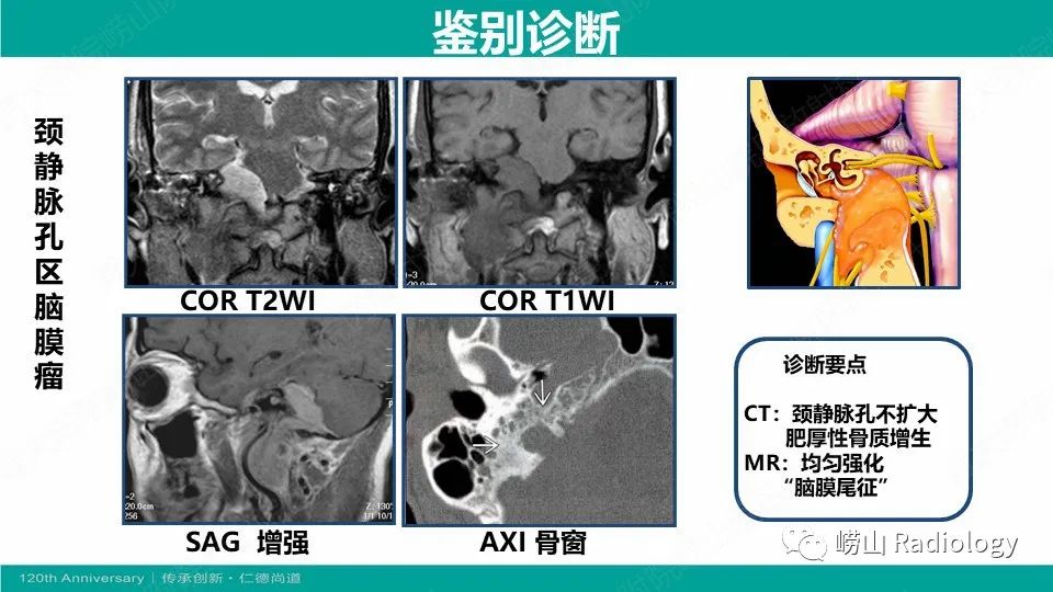 影像PPT - 【病例】颈静脉孔区副神经节瘤(颈静脉球瘤)1例CT及MR-23