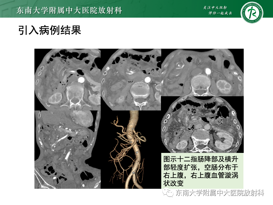影像PPT - 【PPT】肠旋转不良-3 影像PPT - 【PPT】肠旋转不良-3