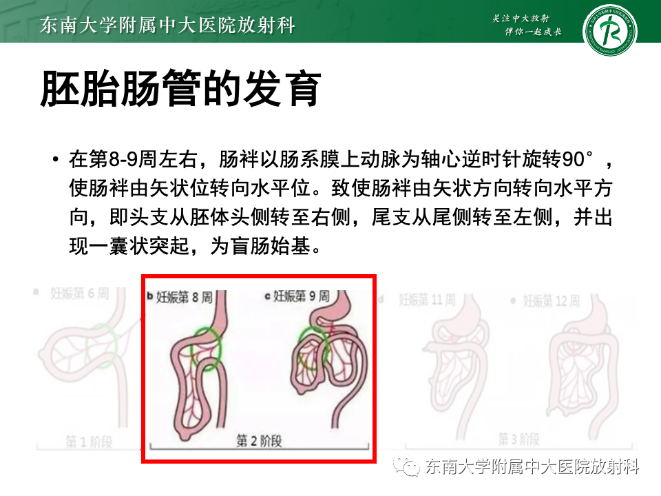 影像PPT - 【PPT】肠旋转不良-11 影像PPT - 【PPT】肠旋转不良-11