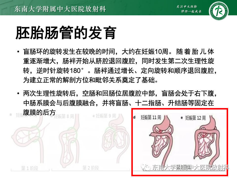 影像PPT - 【PPT】肠旋转不良-12 影像PPT - 【PPT】肠旋转不良-12