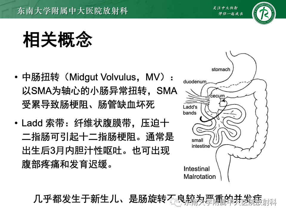 影像PPT - 【PPT】肠旋转不良-17 影像PPT - 【PPT】肠旋转不良-17