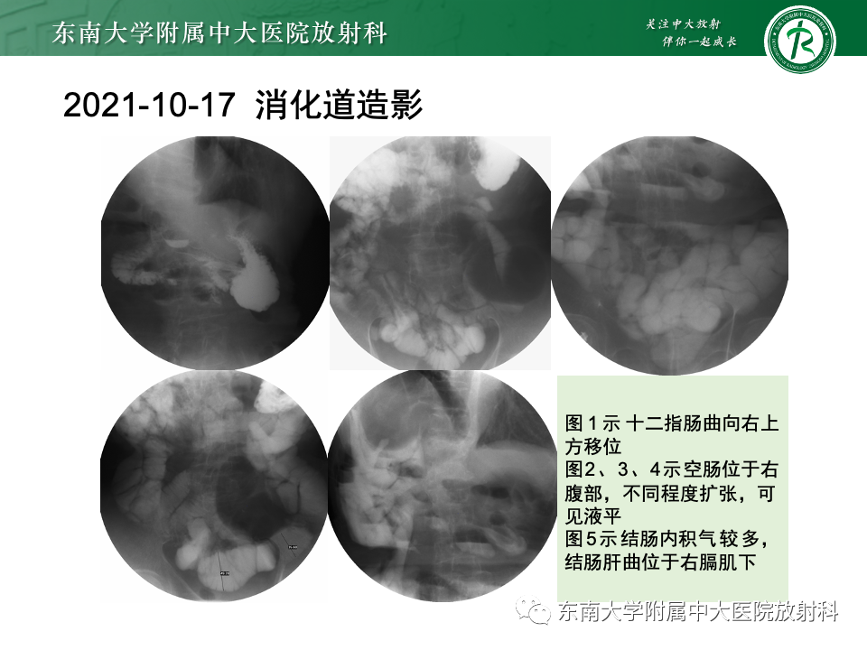 影像PPT - 【PPT】肠旋转不良-4 影像PPT - 【PPT】肠旋转不良-4