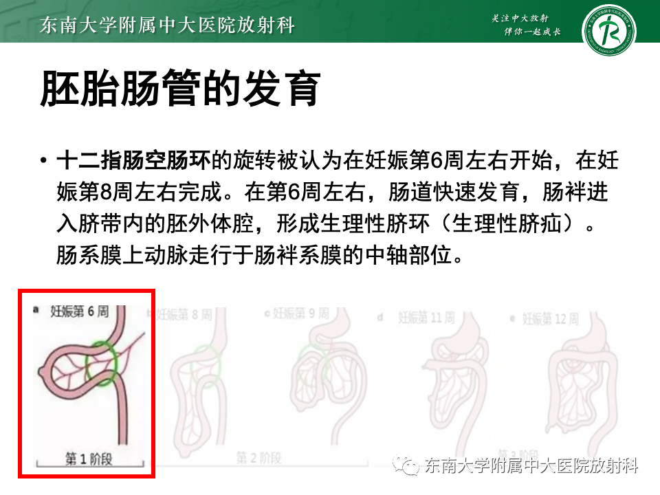 影像PPT - 【PPT】肠旋转不良-10 影像PPT - 【PPT】肠旋转不良-10