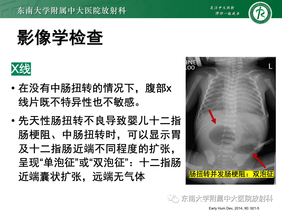 影像PPT - 【PPT】肠旋转不良-20 影像PPT - 【PPT】肠旋转不良-20
