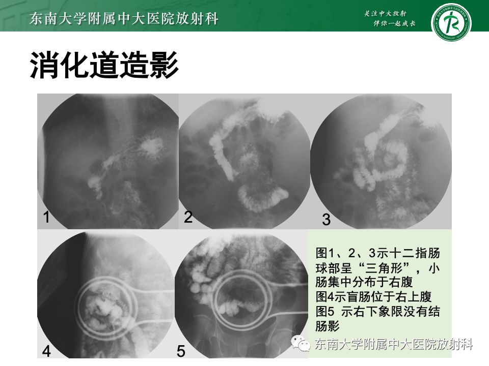影像PPT - 【PPT】肠旋转不良-24 影像PPT - 【PPT】肠旋转不良-24