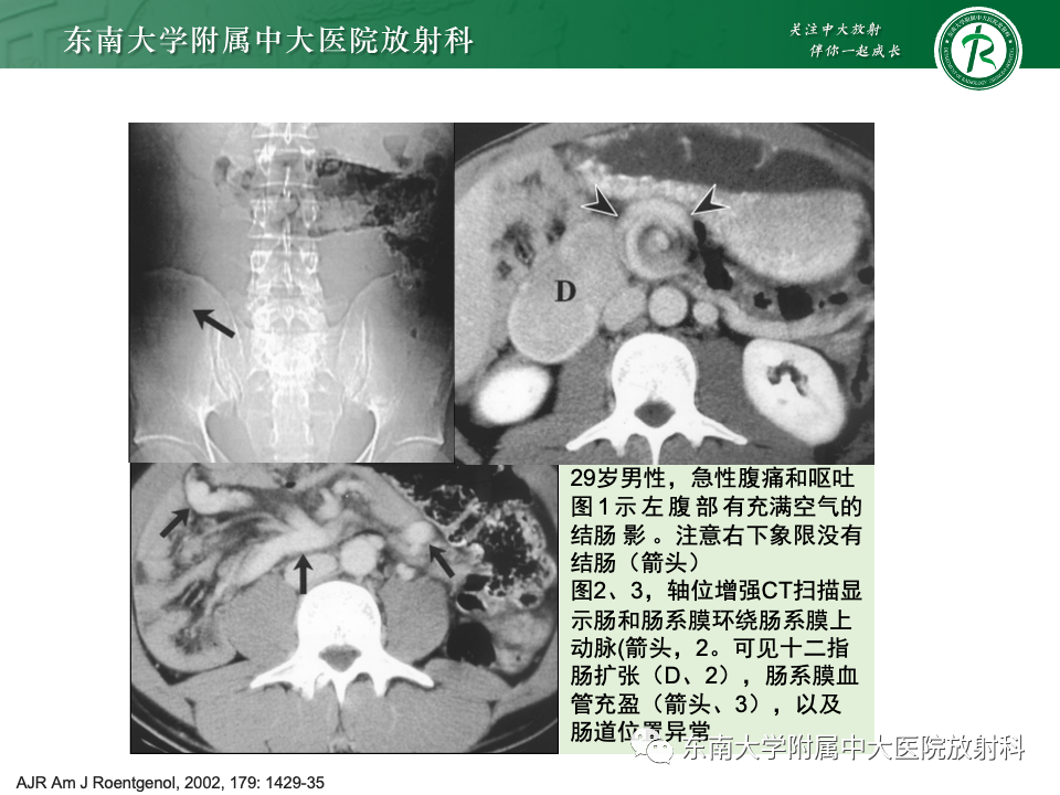 影像PPT - 【PPT】肠旋转不良-29 影像PPT - 【PPT】肠旋转不良-29