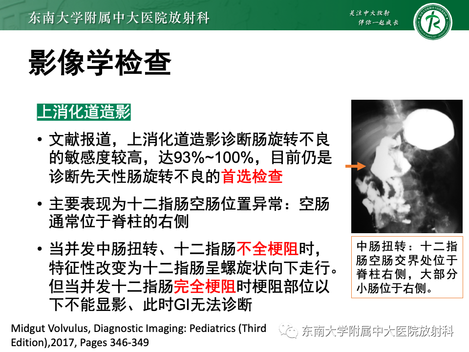影像PPT - 【PPT】肠旋转不良-21 影像PPT - 【PPT】肠旋转不良-21