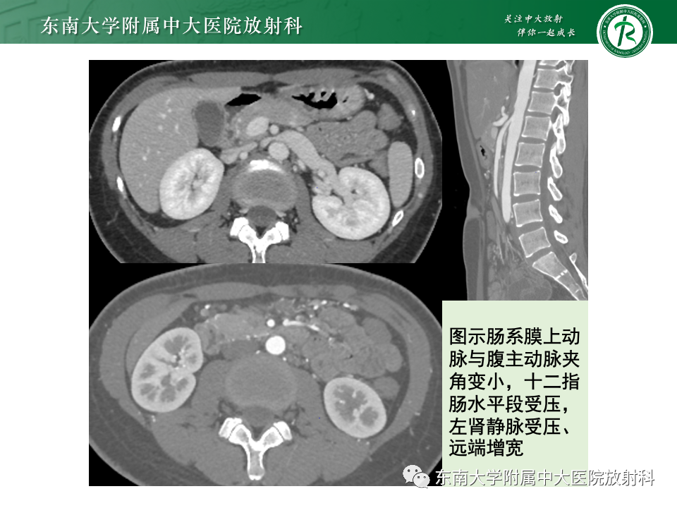 影像PPT - 【PPT】肠旋转不良-32 影像PPT - 【PPT】肠旋转不良-32