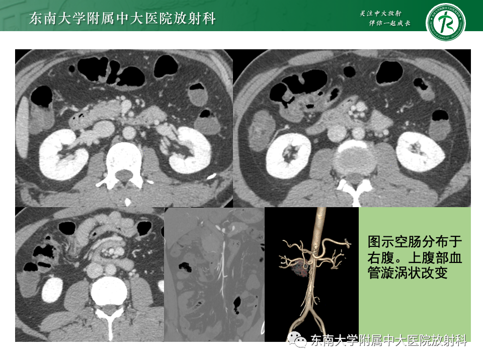 影像PPT - 【PPT】肠旋转不良-27 影像PPT - 【PPT】肠旋转不良-27