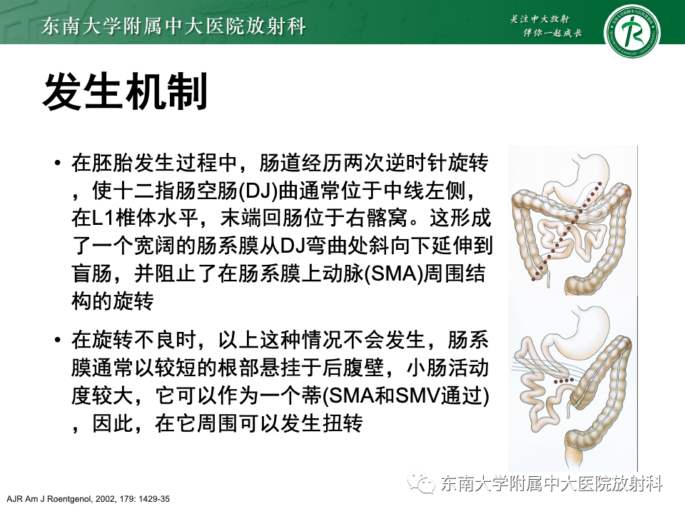 影像PPT - 【PPT】肠旋转不良-2 影像PPT - 【PPT】肠旋转不良-2