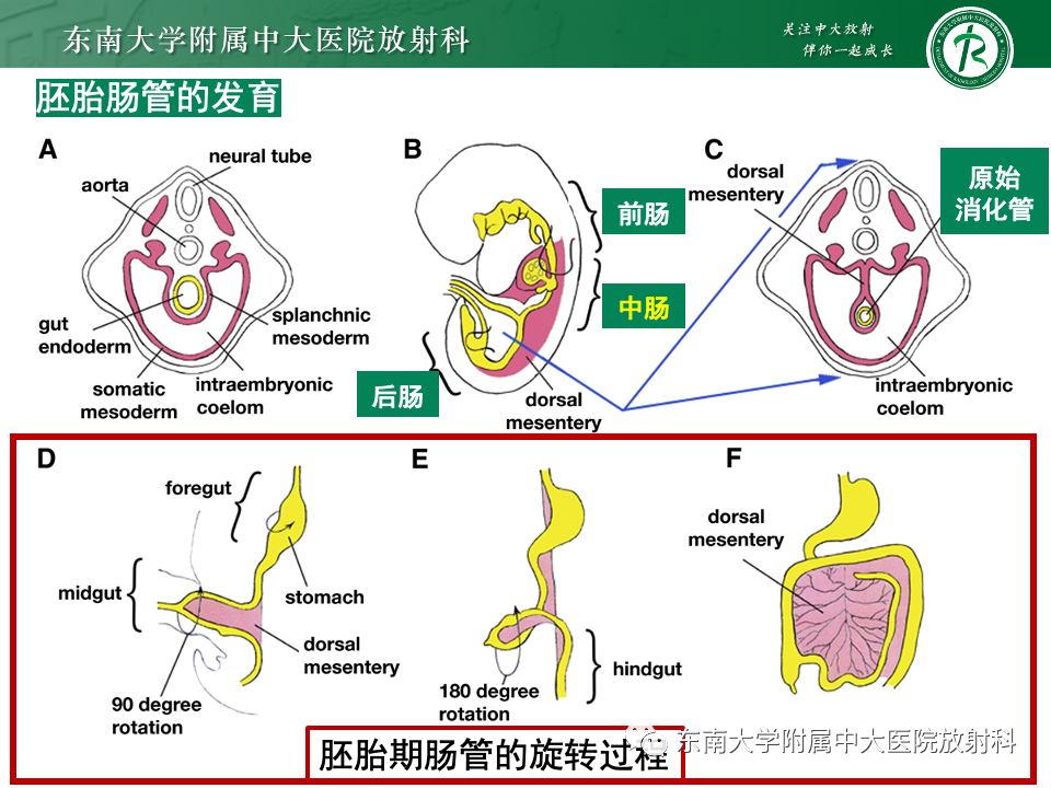 影像PPT - 【PPT】肠旋转不良-1 影像PPT - 【PPT】肠旋转不良-1