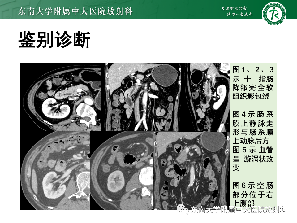 影像PPT - 【PPT】肠旋转不良-5 影像PPT - 【PPT】肠旋转不良-5