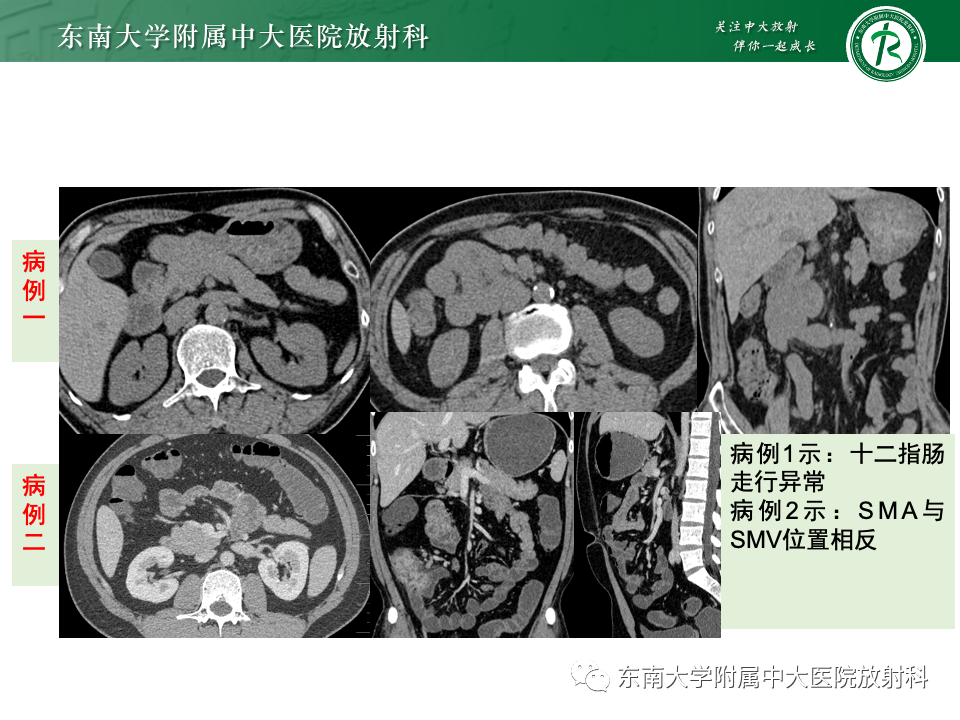 影像PPT - 【PPT】肠旋转不良-3 影像PPT - 【PPT】肠旋转不良-3