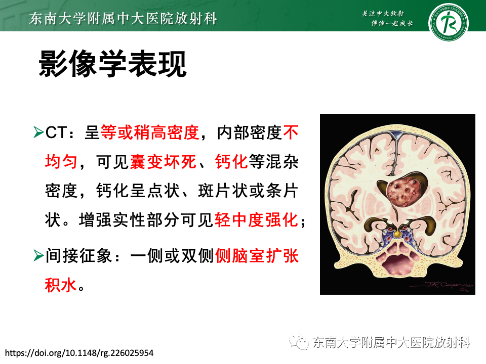 影像PPT - 【PPT】中枢神经细胞瘤-11 影像PPT - 【PPT】中枢神经细胞瘤-11