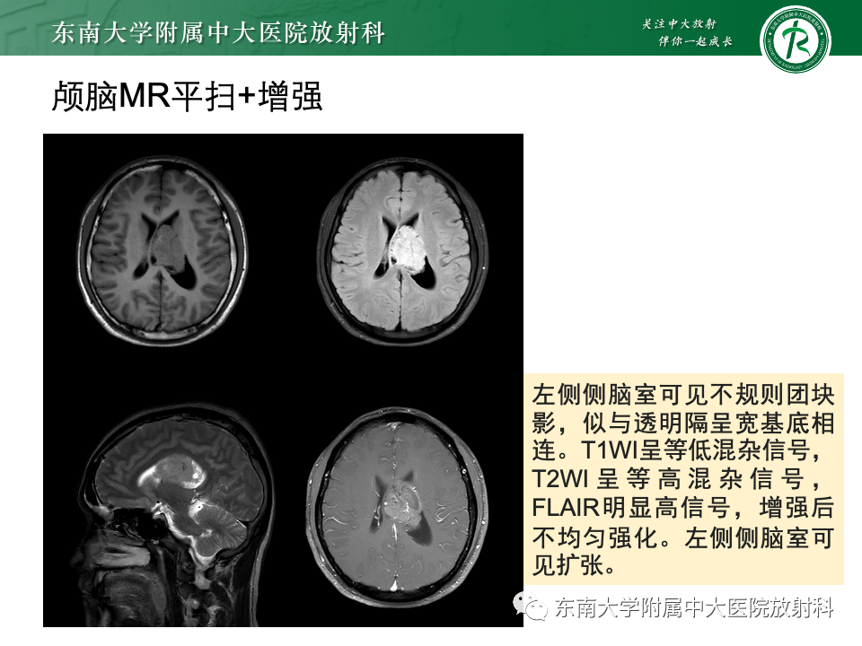 影像PPT - 【PPT】中枢神经细胞瘤-3 影像PPT - 【PPT】中枢神经细胞瘤-3