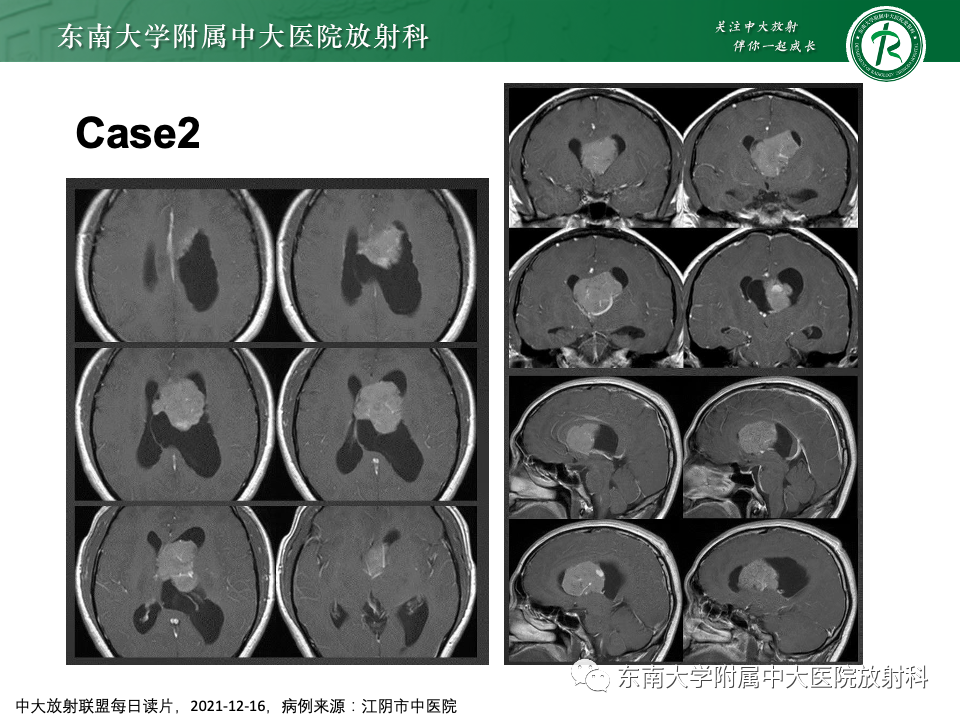 影像PPT - 【PPT】中枢神经细胞瘤-18 影像PPT - 【PPT】中枢神经细胞瘤-18