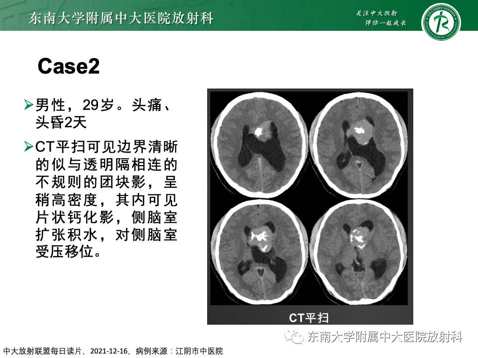 影像PPT - 【PPT】中枢神经细胞瘤-15 影像PPT - 【PPT】中枢神经细胞瘤-15