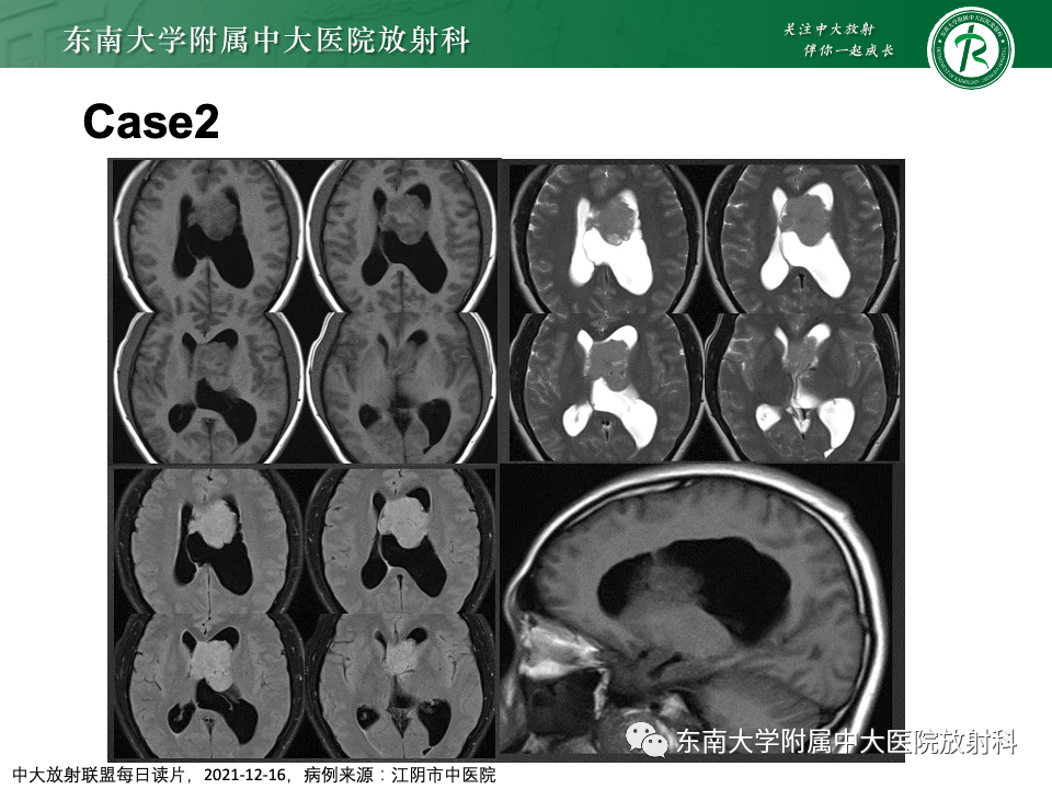 影像PPT - 【PPT】中枢神经细胞瘤-16 影像PPT - 【PPT】中枢神经细胞瘤-16