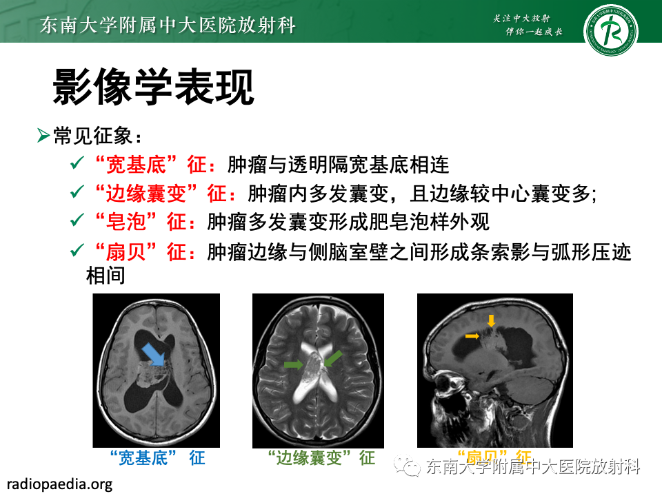 影像PPT - 【PPT】中枢神经细胞瘤-13 影像PPT - 【PPT】中枢神经细胞瘤-13