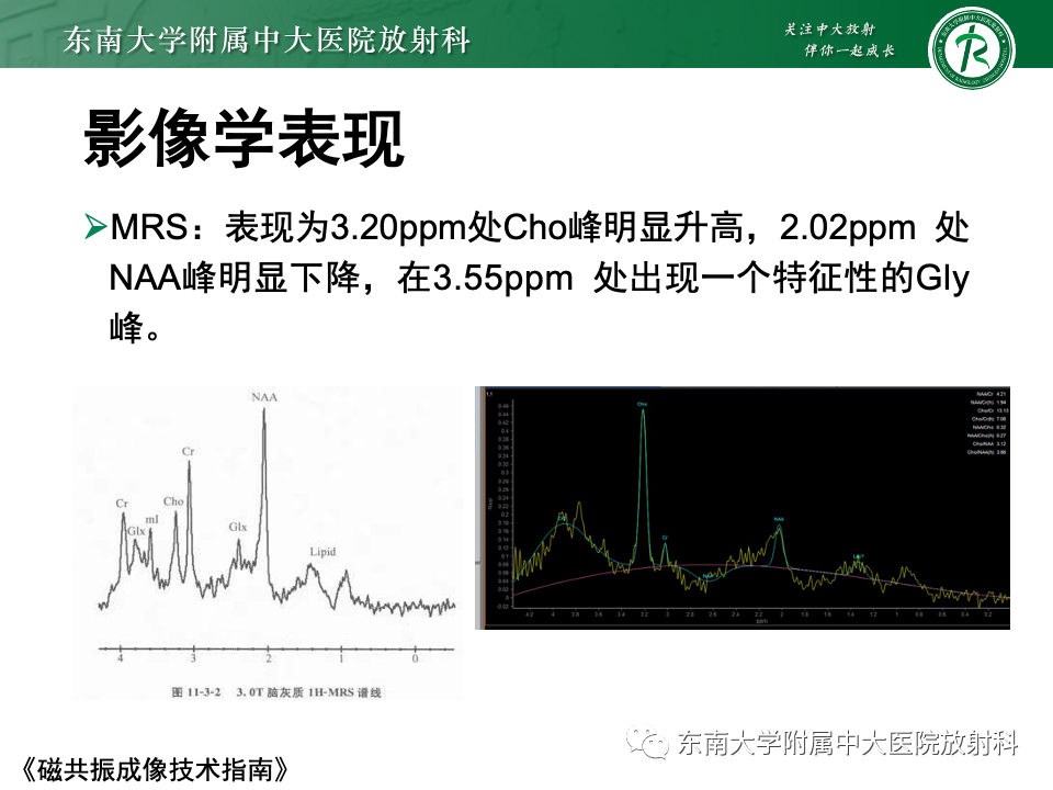 影像PPT - 【PPT】中枢神经细胞瘤-14 影像PPT - 【PPT】中枢神经细胞瘤-14