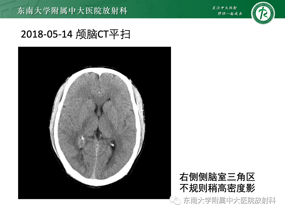 影像PPT - 【PPT】中枢神经细胞瘤-28 影像PPT - 【PPT】中枢神经细胞瘤-28
