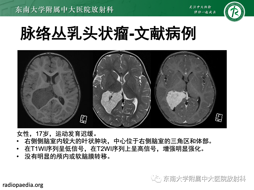 影像PPT - 【PPT】中枢神经细胞瘤-30 影像PPT - 【PPT】中枢神经细胞瘤-30