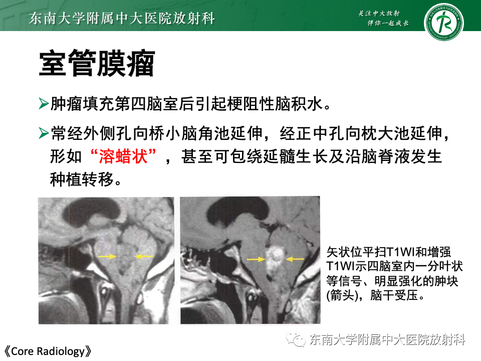 影像PPT - 【PPT】中枢神经细胞瘤-32 影像PPT - 【PPT】中枢神经细胞瘤-32